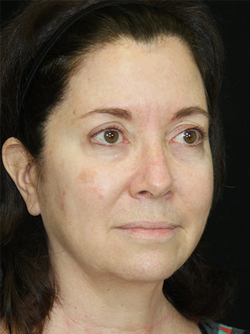 Facelift & Neck Lift Before & After Gallery - Patient 143521985 - Image 9