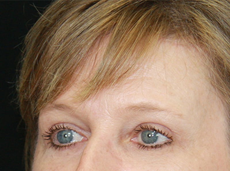 Eyelid Surgery Before & After Gallery - Patient 143521987 - Image 4