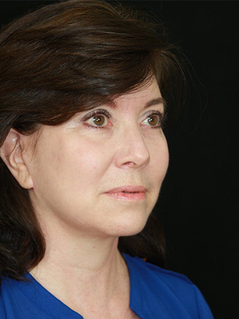 Facelift & Neck Lift Before & After Gallery - Patient 143521985 - Image 10