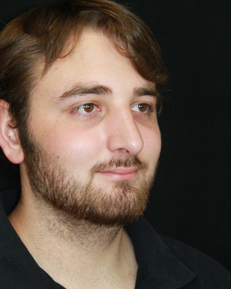 Rhinoplasty Before & After Gallery - Patient 143521986 - Image 4