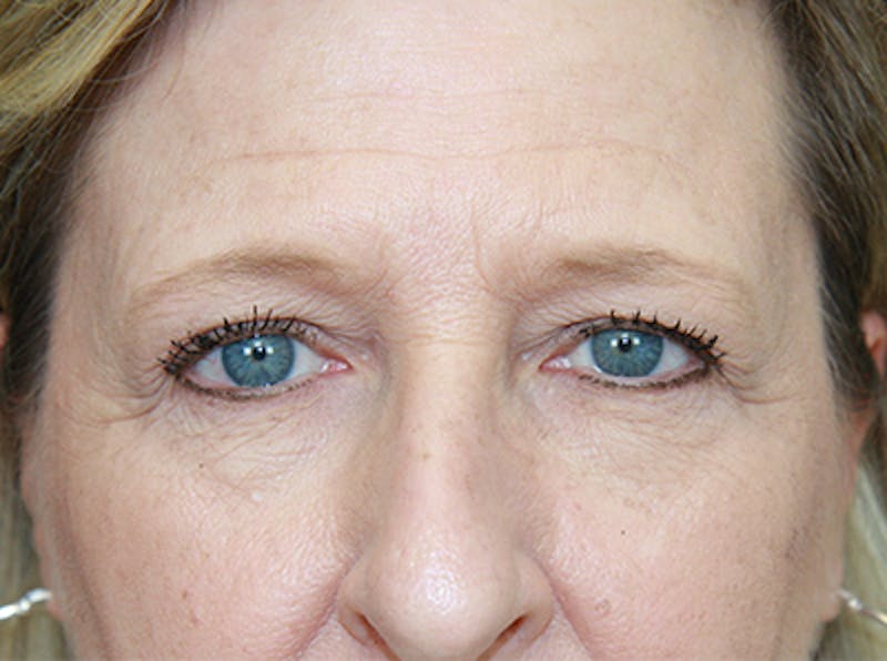 Eyelid Surgery Before & After Gallery - Patient 143521987 - Image 5