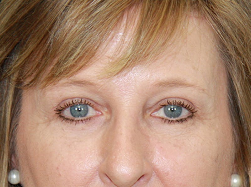 Eyelid Surgery Before & After Gallery - Patient 143521987 - Image 6