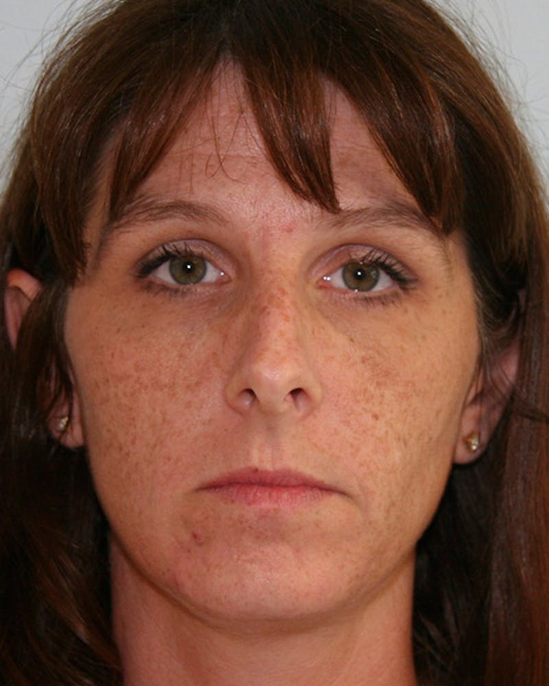 Rhinoplasty Before & After Gallery - Patient 143522004 - Image 1