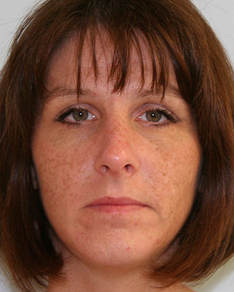Rhinoplasty Before & After Gallery - Patient 143522004 - Image 2
