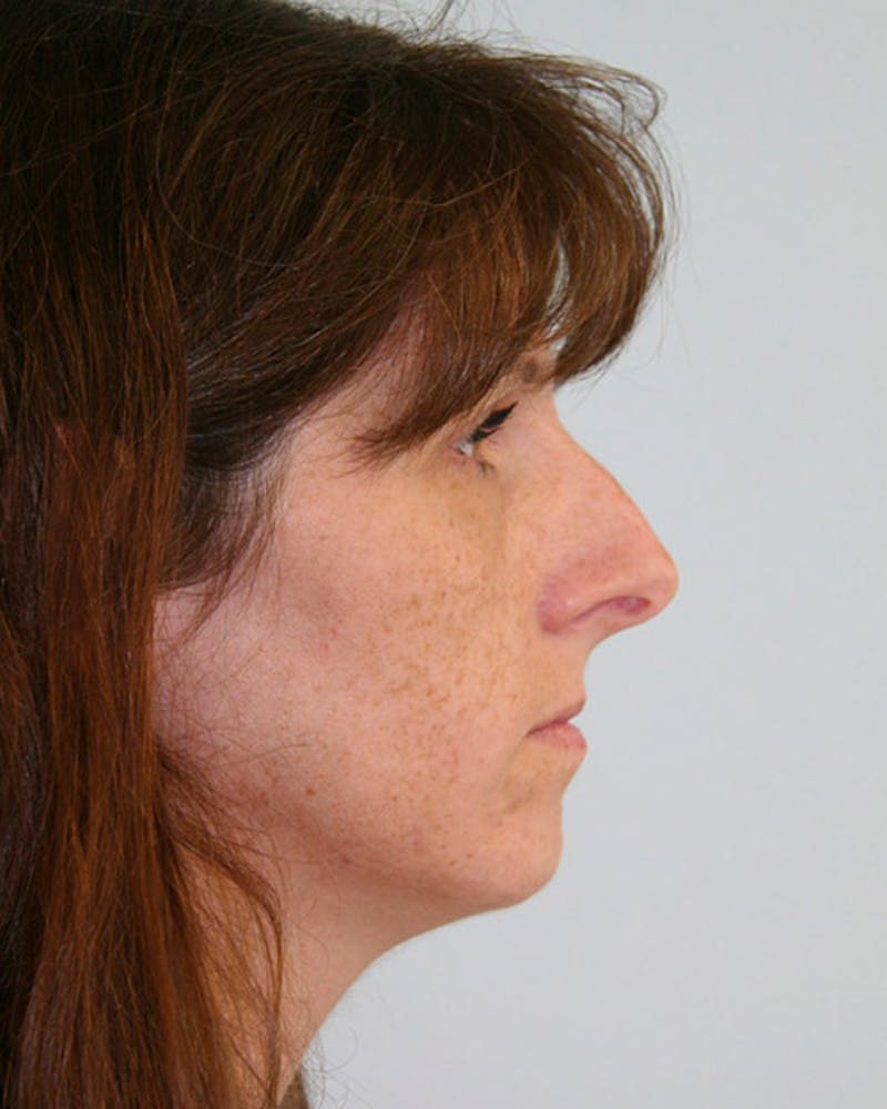 Rhinoplasty Before & After Gallery - Patient 143522004 - Image 3