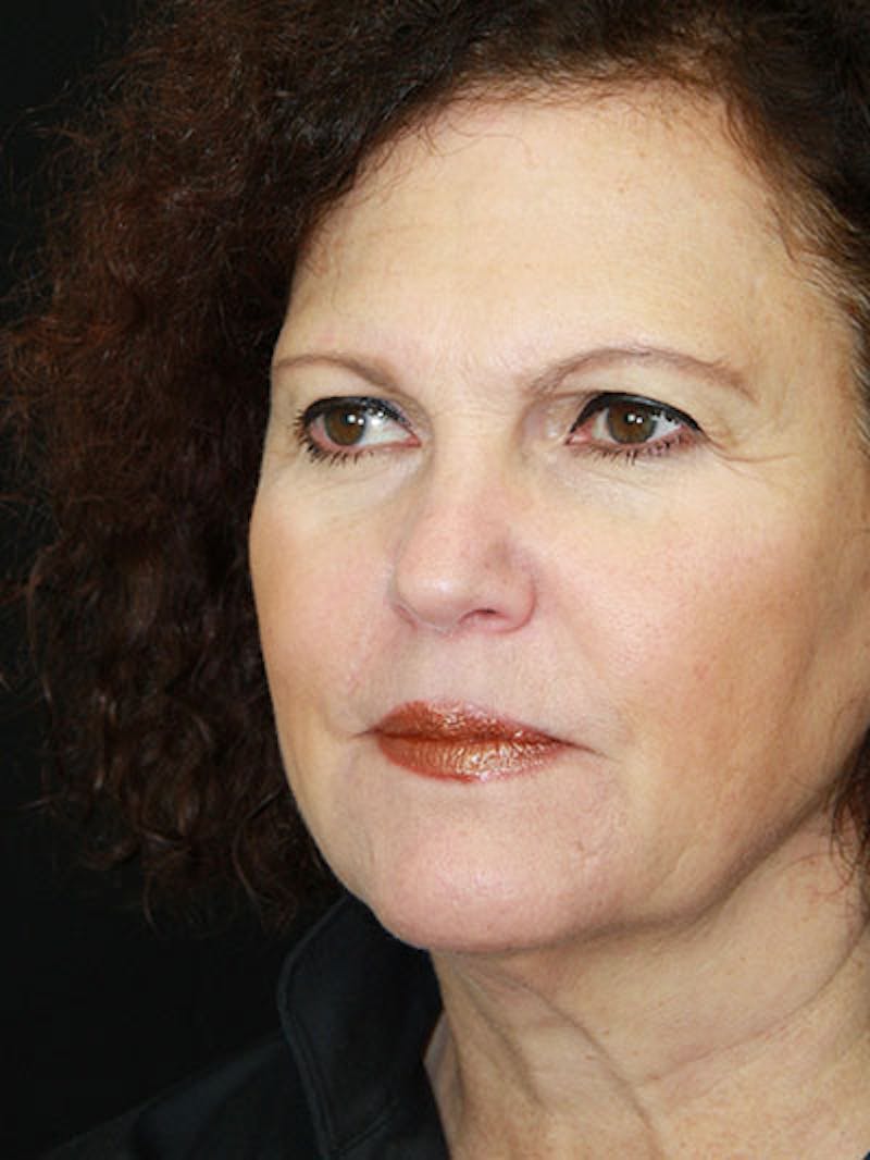 Facelift & Neck Lift Before & After Gallery - Patient 143521989 - Image 3