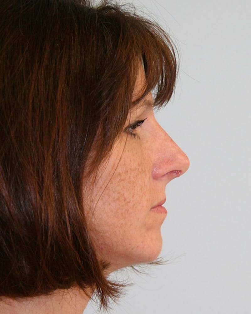 Rhinoplasty Before & After Gallery - Patient 143522004 - Image 4