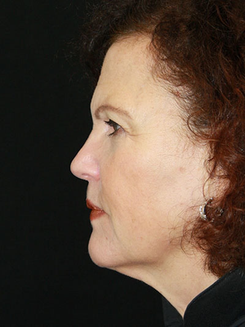 Facelift & Neck Lift Before & After Gallery - Patient 143521989 - Image 5