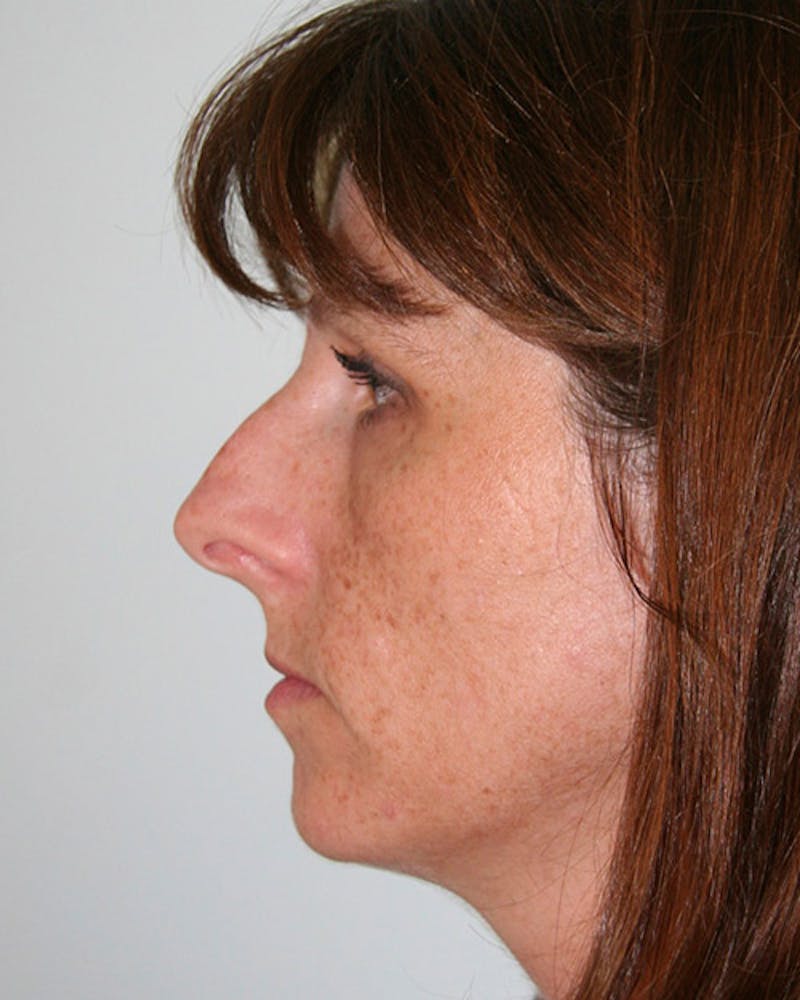 Rhinoplasty Before & After Gallery - Patient 143522004 - Image 5