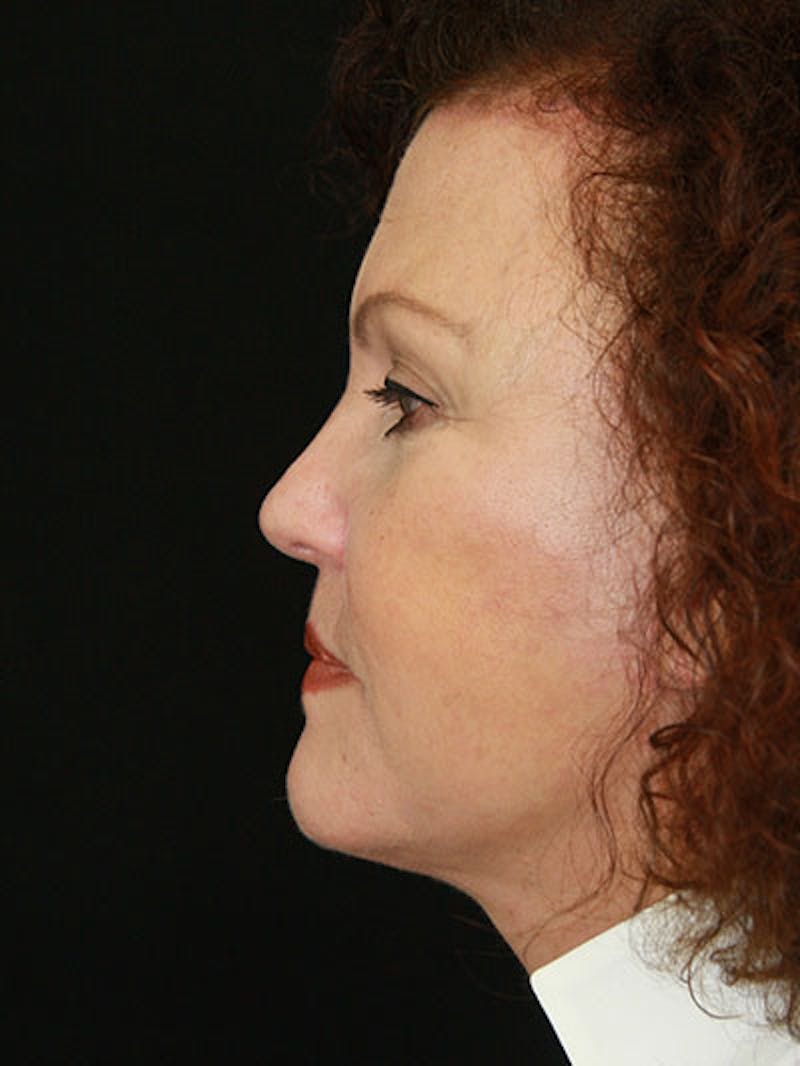Facelift & Neck Lift Before & After Gallery - Patient 143521989 - Image 6