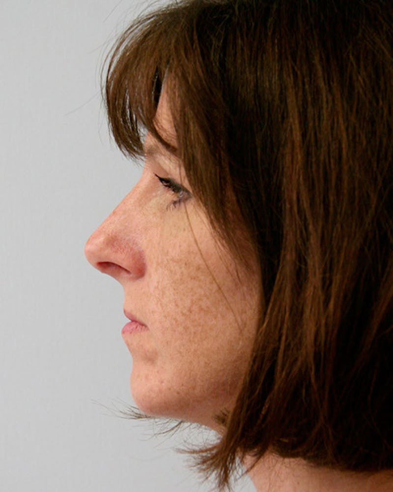 Rhinoplasty Before & After Gallery - Patient 143522004 - Image 6