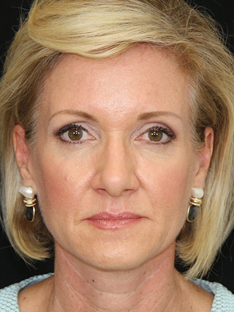 Facelift & Neck Lift Before & After Gallery - Patient 143522037 - Image 1