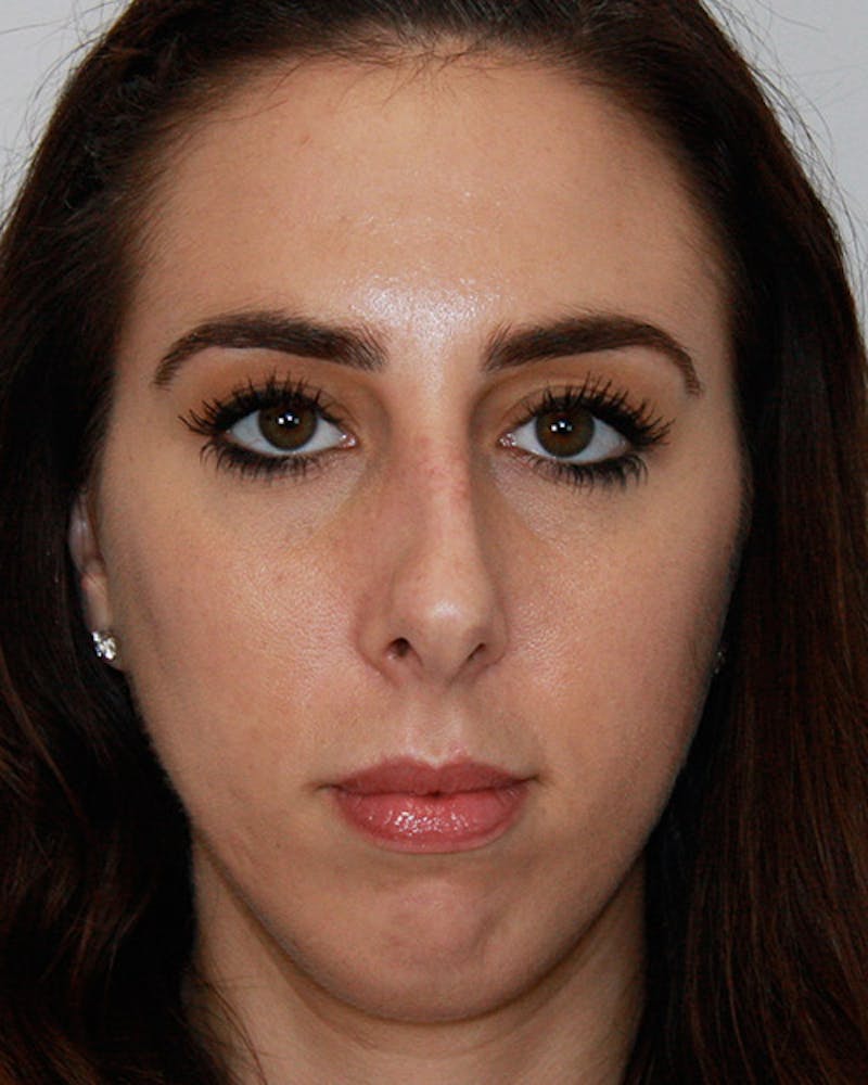 Rhinoplasty Before & After Gallery - Patient 143522036 - Image 1