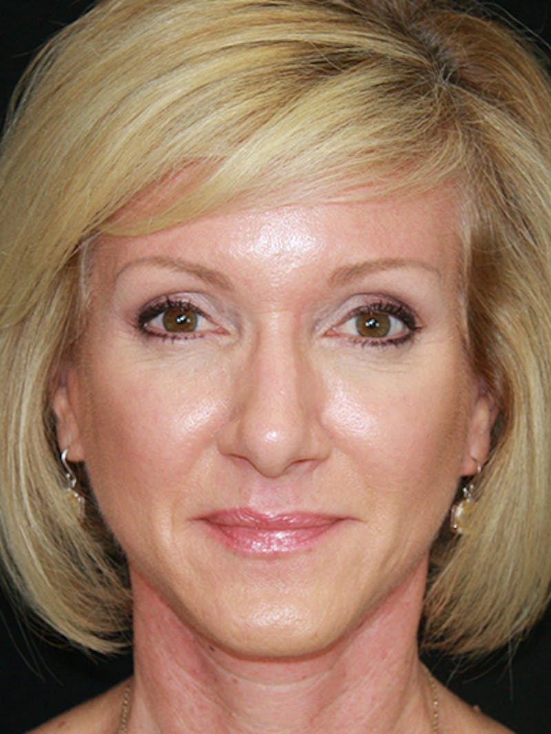 Facelift & Neck Lift Before & After Gallery - Patient 143522037 - Image 2