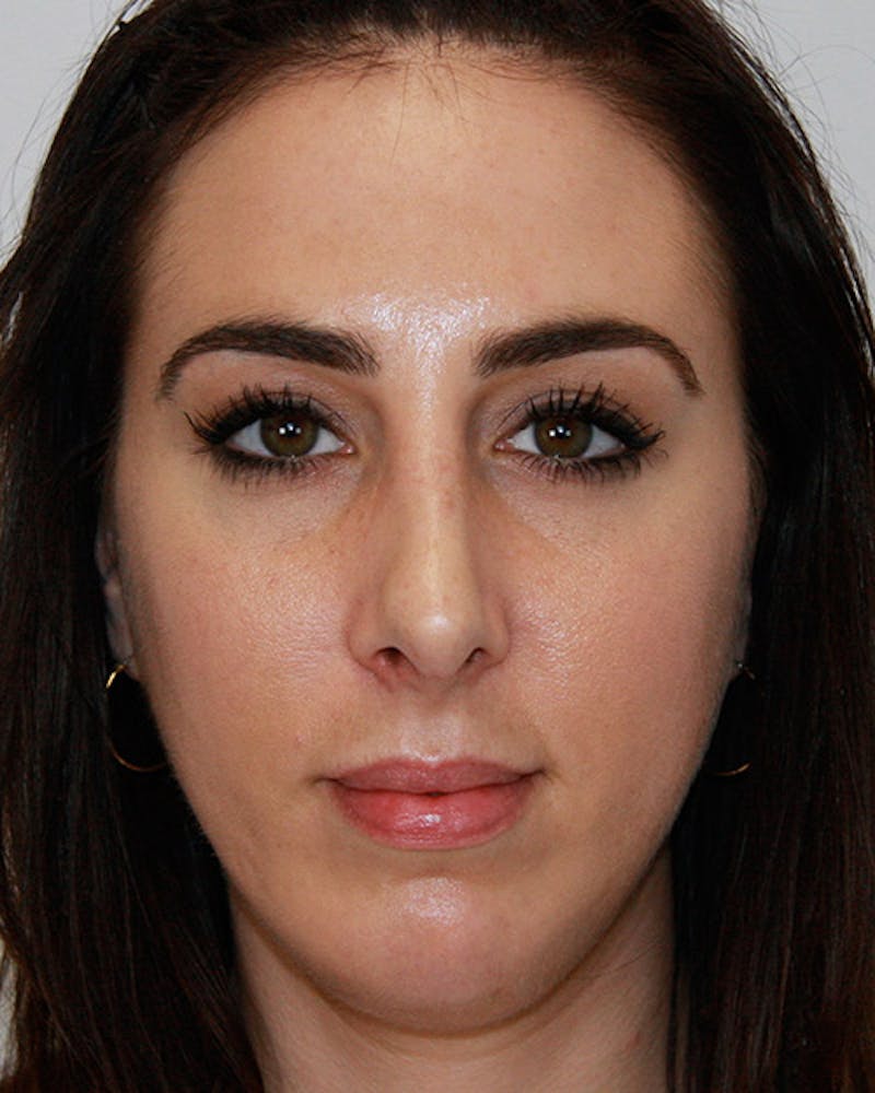 Rhinoplasty Before & After Gallery - Patient 143522036 - Image 2
