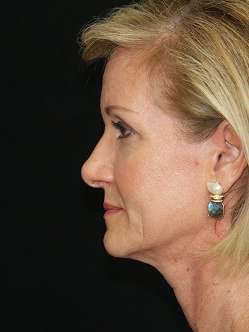Facelift & Neck Lift Before & After Gallery - Patient 143522037 - Image 3