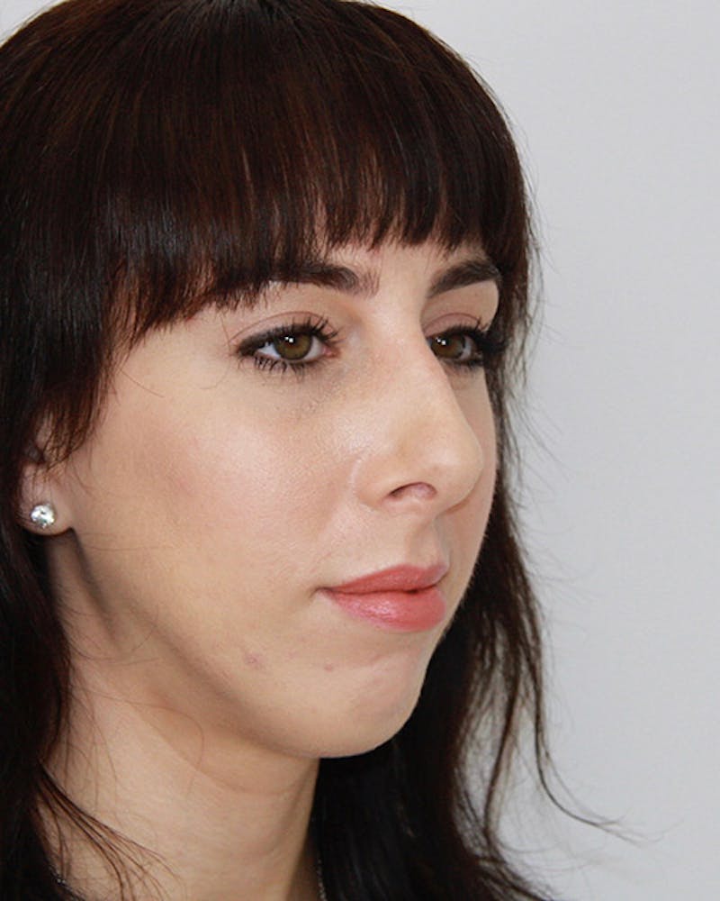 Rhinoplasty Before & After Gallery - Patient 143522036 - Image 3