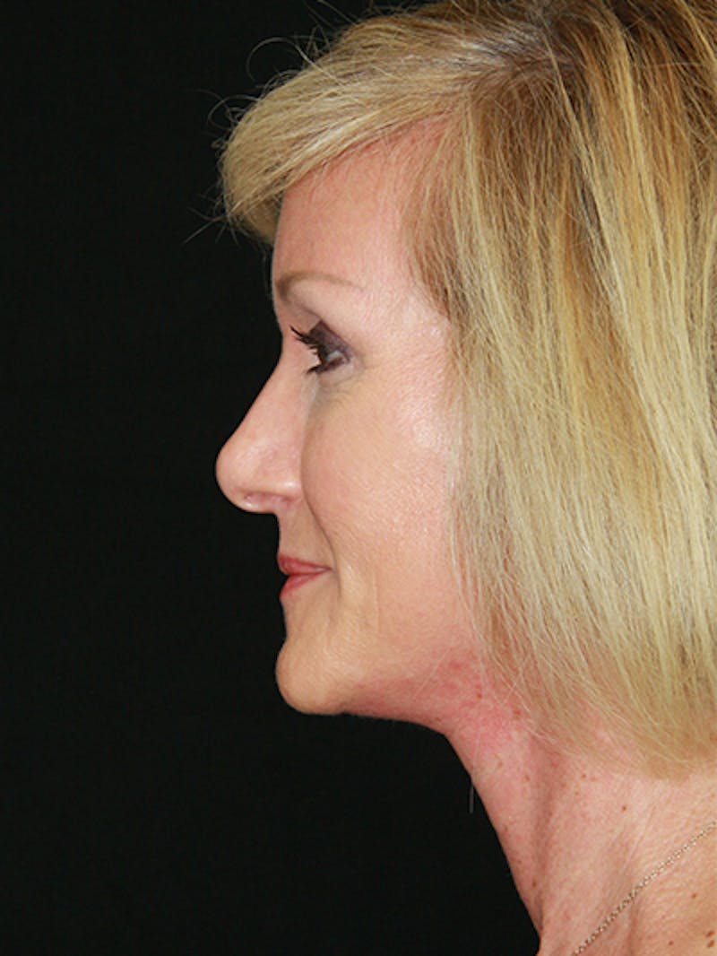 Facelift & Neck Lift Before & After Gallery - Patient 143522037 - Image 4