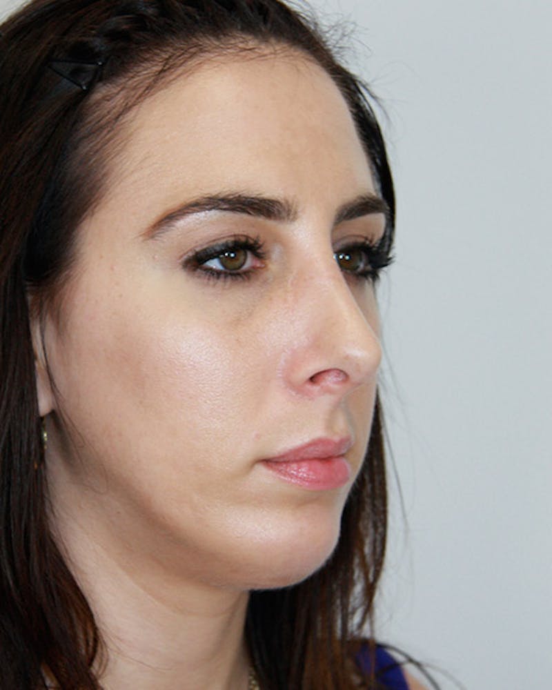 Rhinoplasty Before & After Gallery - Patient 143522036 - Image 4