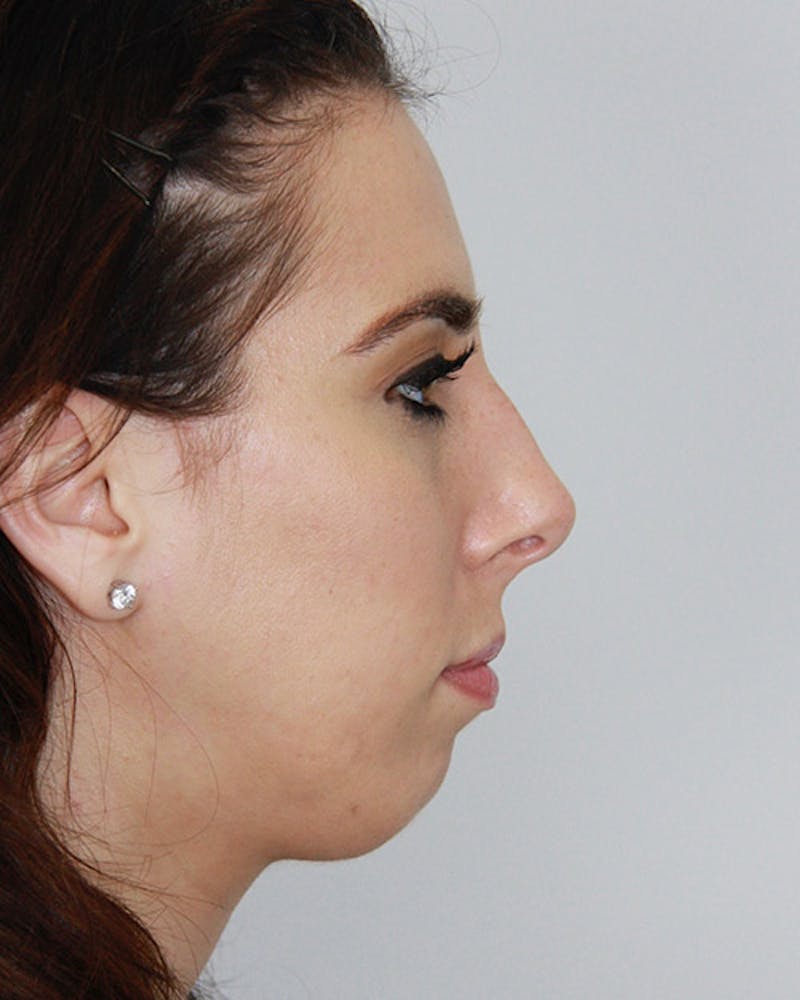 Rhinoplasty Before & After Gallery - Patient 143522036 - Image 5