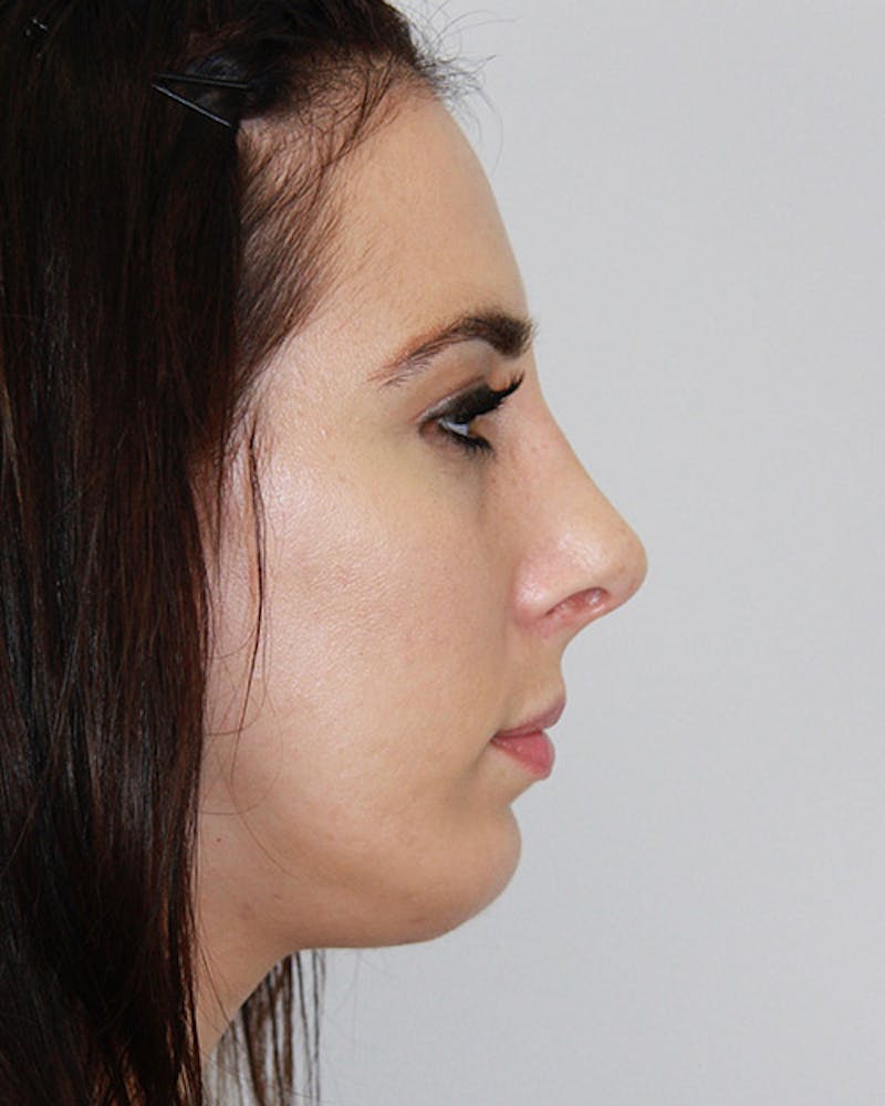Rhinoplasty Before & After Gallery - Patient 143522036 - Image 6