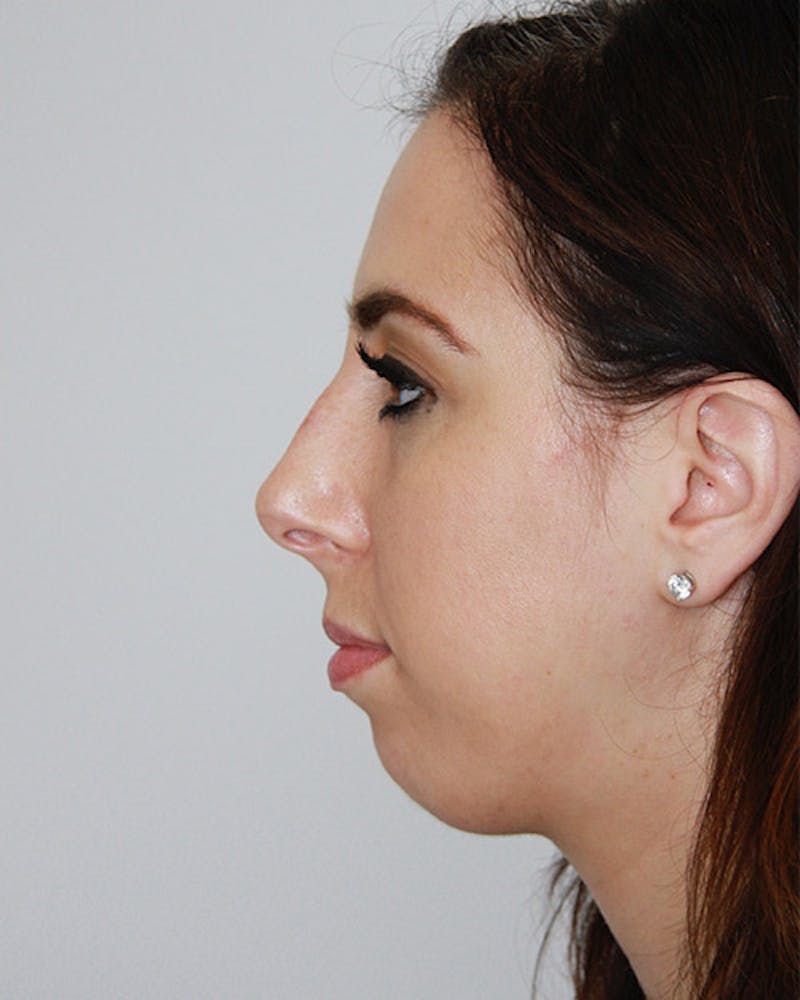 Rhinoplasty Before & After Gallery - Patient 143522036 - Image 7