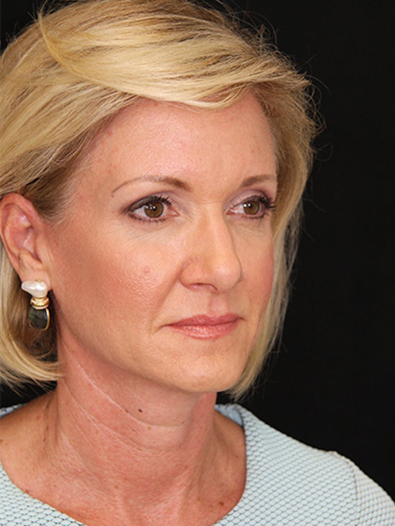 Facelift & Neck Lift Before & After Gallery - Patient 143522037 - Image 7