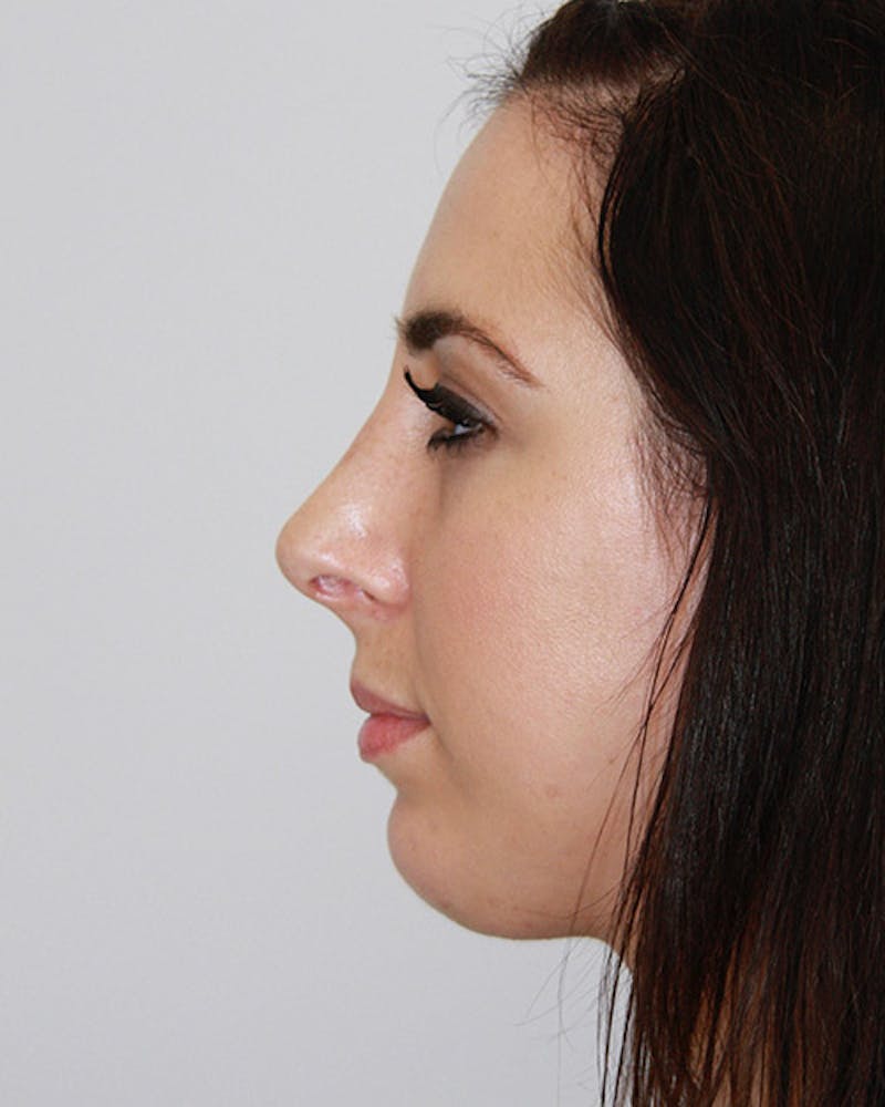 Rhinoplasty Before & After Gallery - Patient 143522036 - Image 8