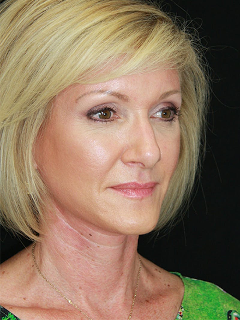 Facelift & Neck Lift Before & After Gallery - Patient 143522037 - Image 8