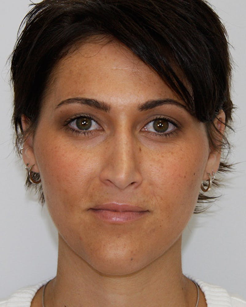 Rhinoplasty Before & After Gallery - Patient 143522067 - Image 1