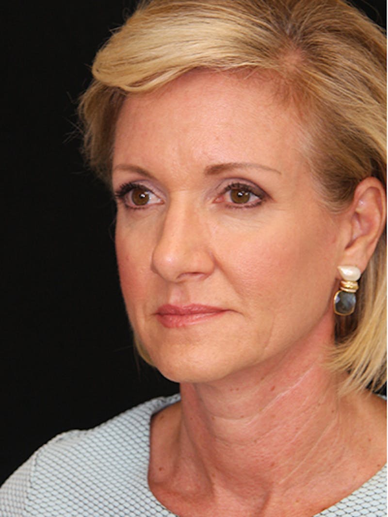Facelift & Neck Lift Before & After Gallery - Patient 143522037 - Image 9