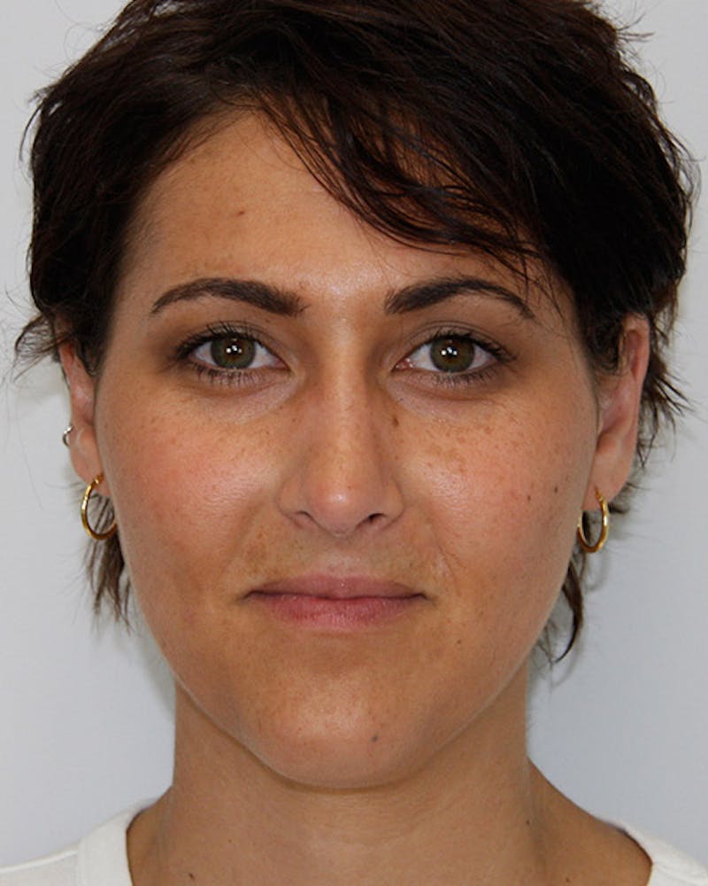 Rhinoplasty Before & After Gallery - Patient 143522067 - Image 2