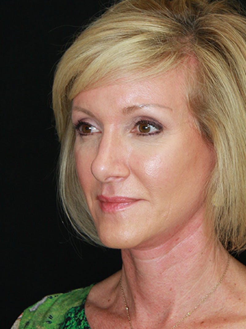 Facelift & Neck Lift Before & After Gallery - Patient 143522037 - Image 10