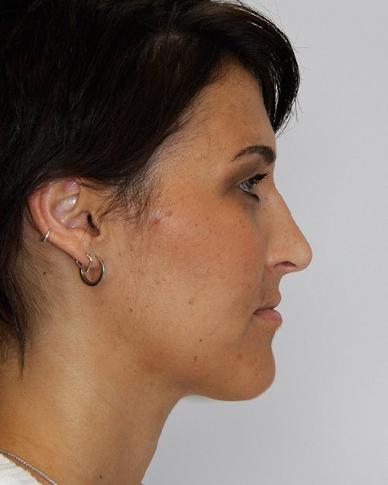 Rhinoplasty Before & After Gallery - Patient 143522067 - Image 3