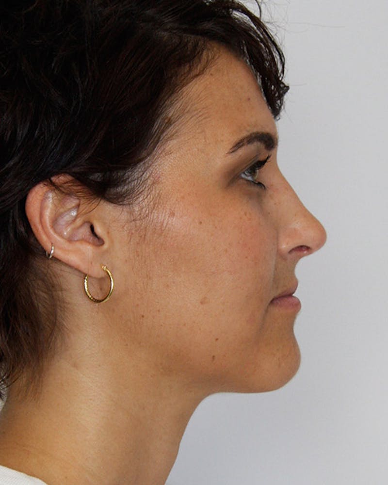Rhinoplasty Before & After Gallery - Patient 143522067 - Image 4