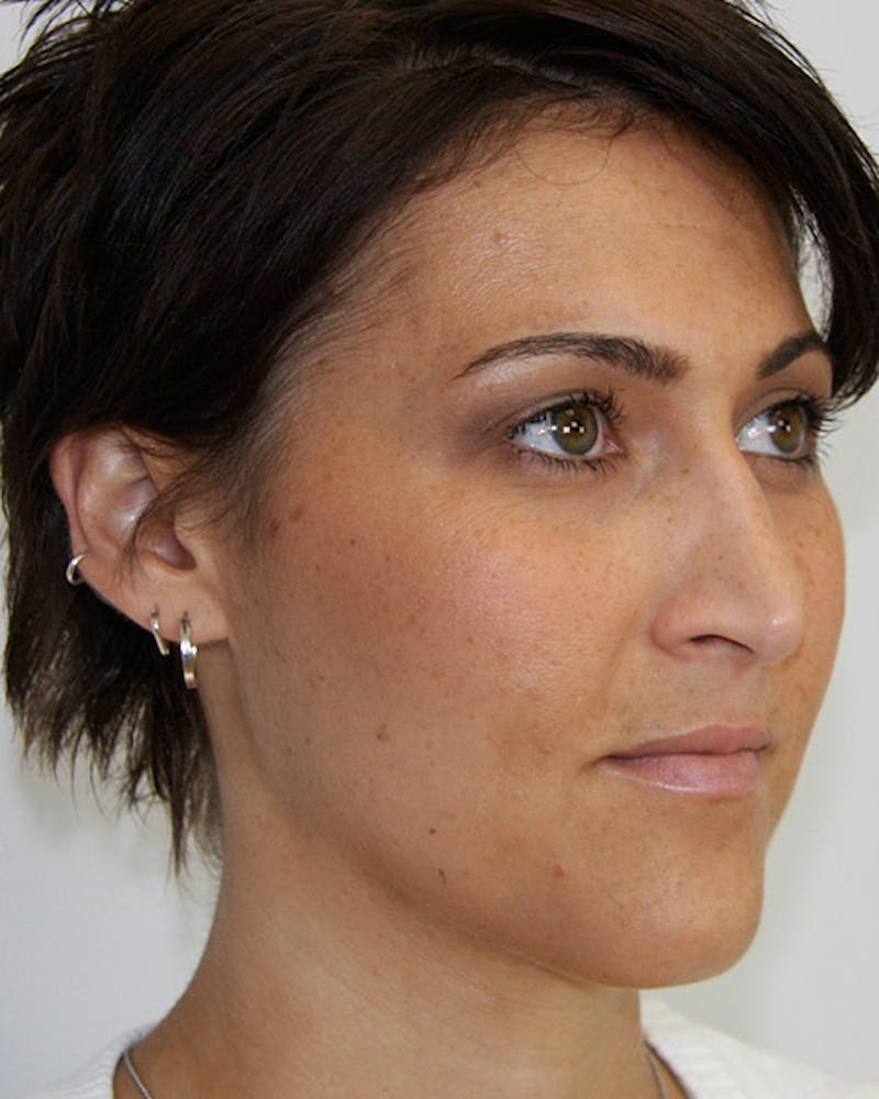 Rhinoplasty Before & After Gallery - Patient 143522067 - Image 5