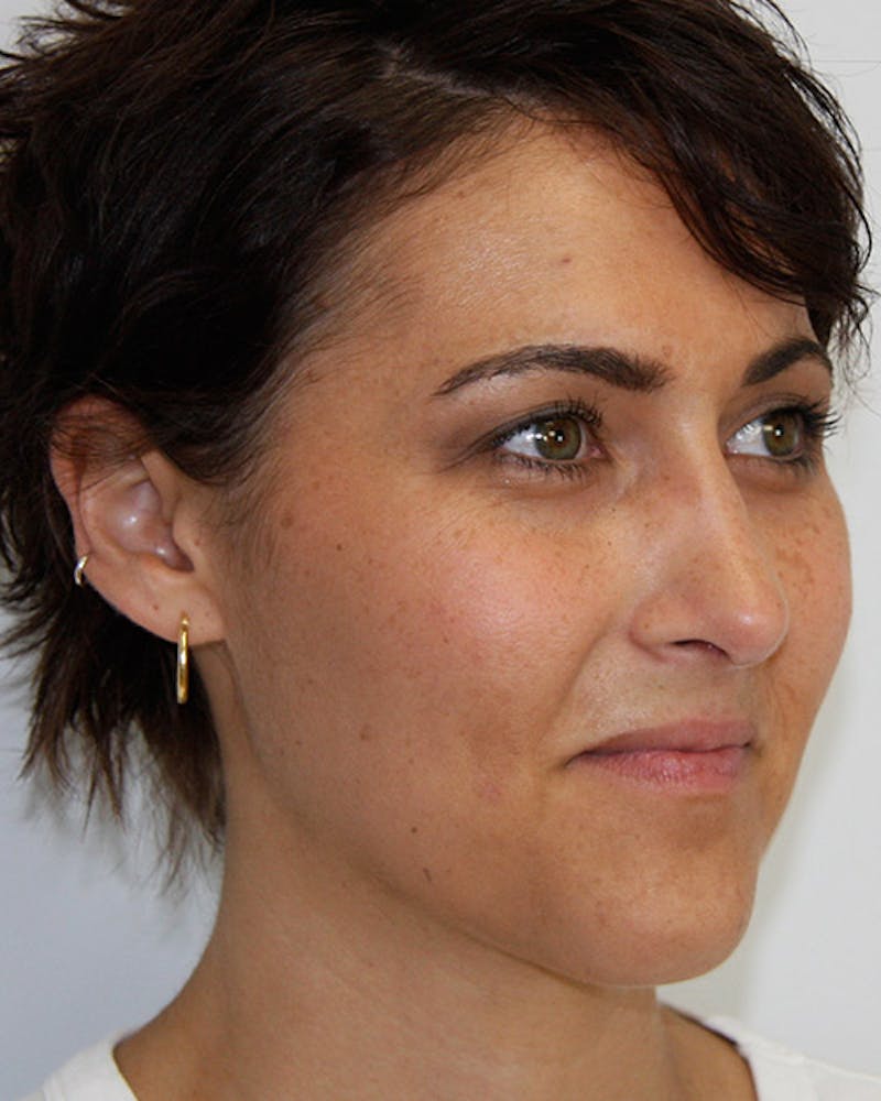 Rhinoplasty Before & After Gallery - Patient 143522067 - Image 6