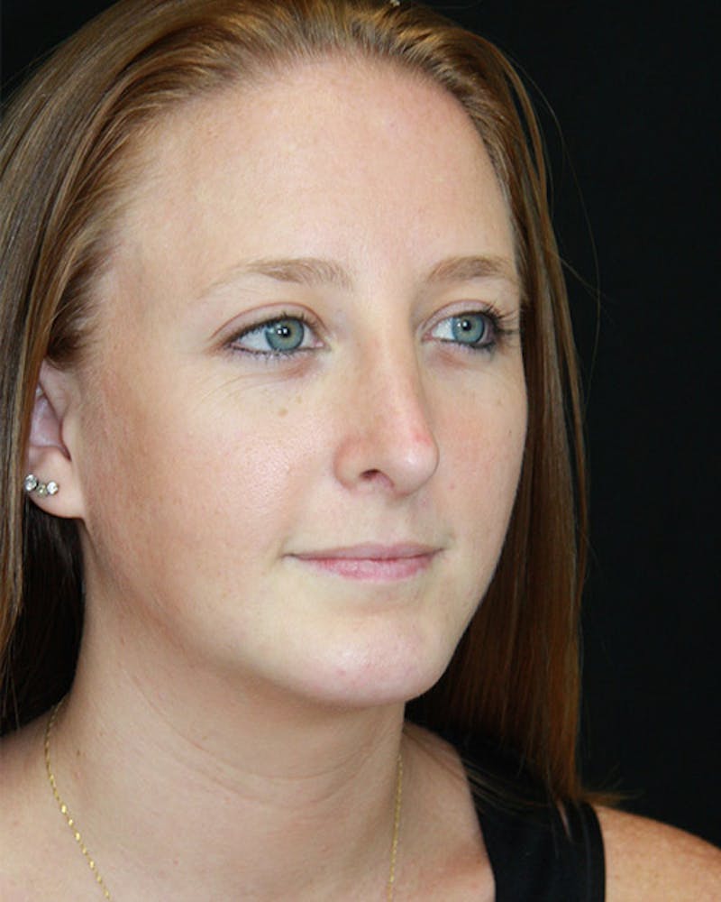 Rhinoplasty Before & After Gallery - Patient 143522075 - Image 2