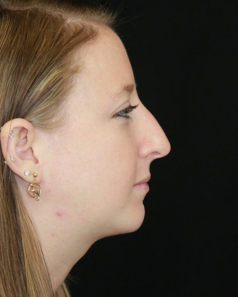 Rhinoplasty Before & After Gallery - Patient 143522075 - Image 3
