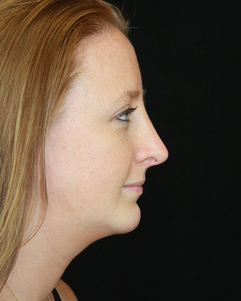 Rhinoplasty Before & After Gallery - Patient 143522075 - Image 4