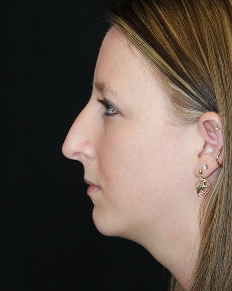 Rhinoplasty Before & After Gallery - Patient 143522075 - Image 5