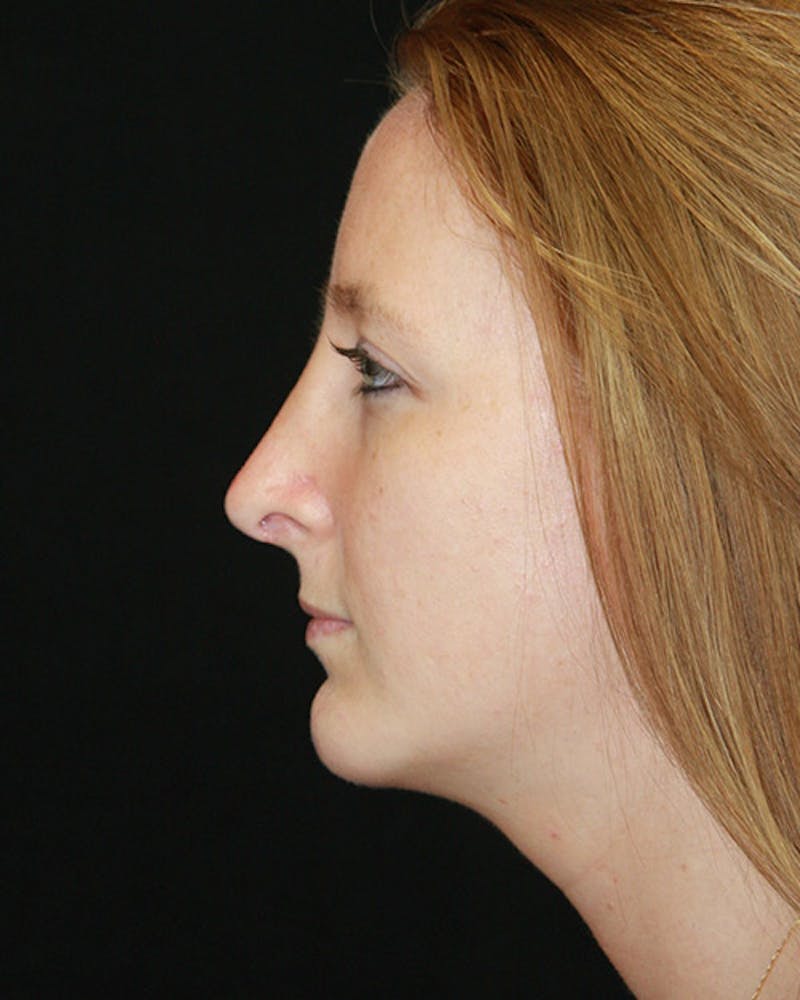 Rhinoplasty Before & After Gallery - Patient 143522075 - Image 6