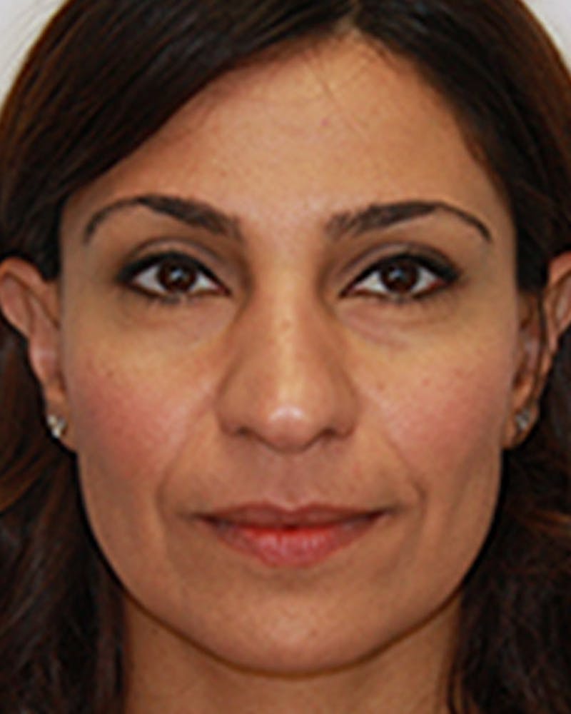 Rhinoplasty Before & After Gallery - Patient 143522088 - Image 1