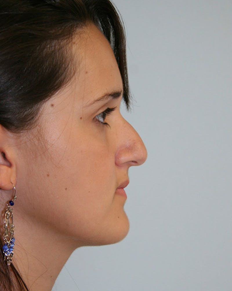 Rhinoplasty Before & After Gallery - Patient 143522090 - Image 1