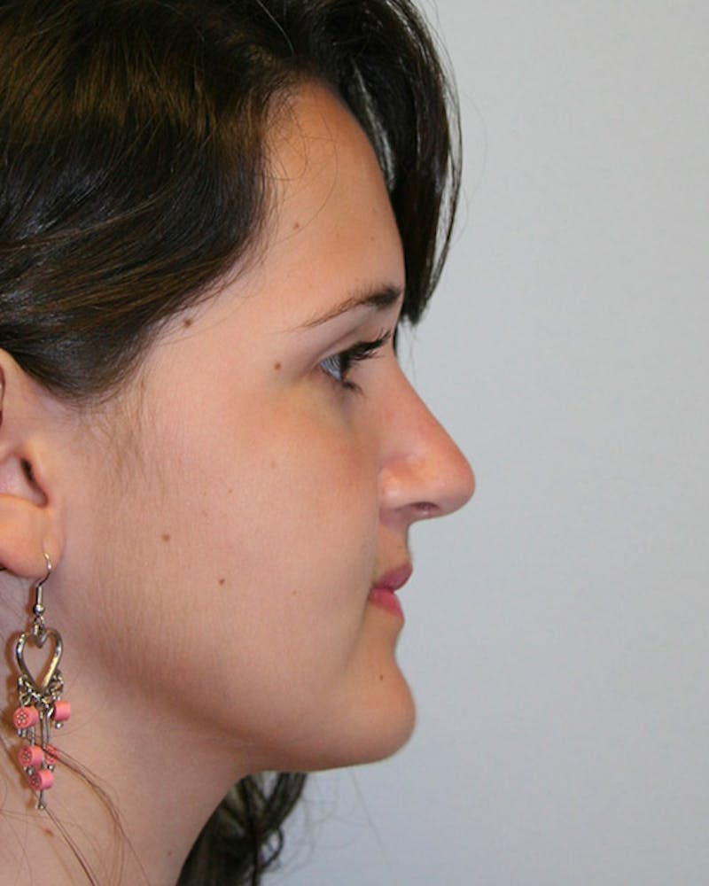 Rhinoplasty Before & After Gallery - Patient 143522090 - Image 2