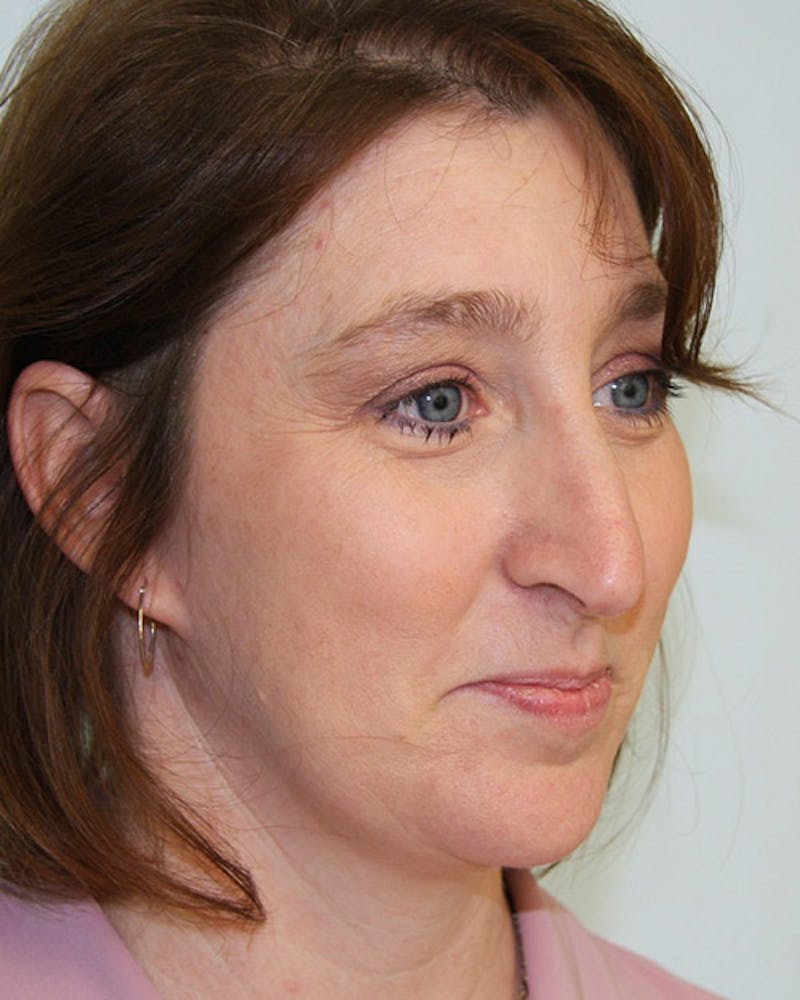 Rhinoplasty Before & After Gallery - Patient 143522100 - Image 1
