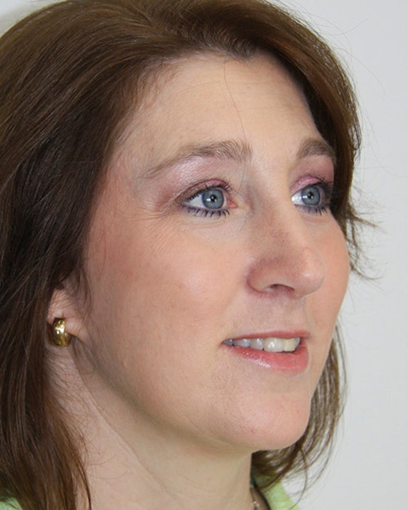 Rhinoplasty Before & After Gallery - Patient 143522100 - Image 2