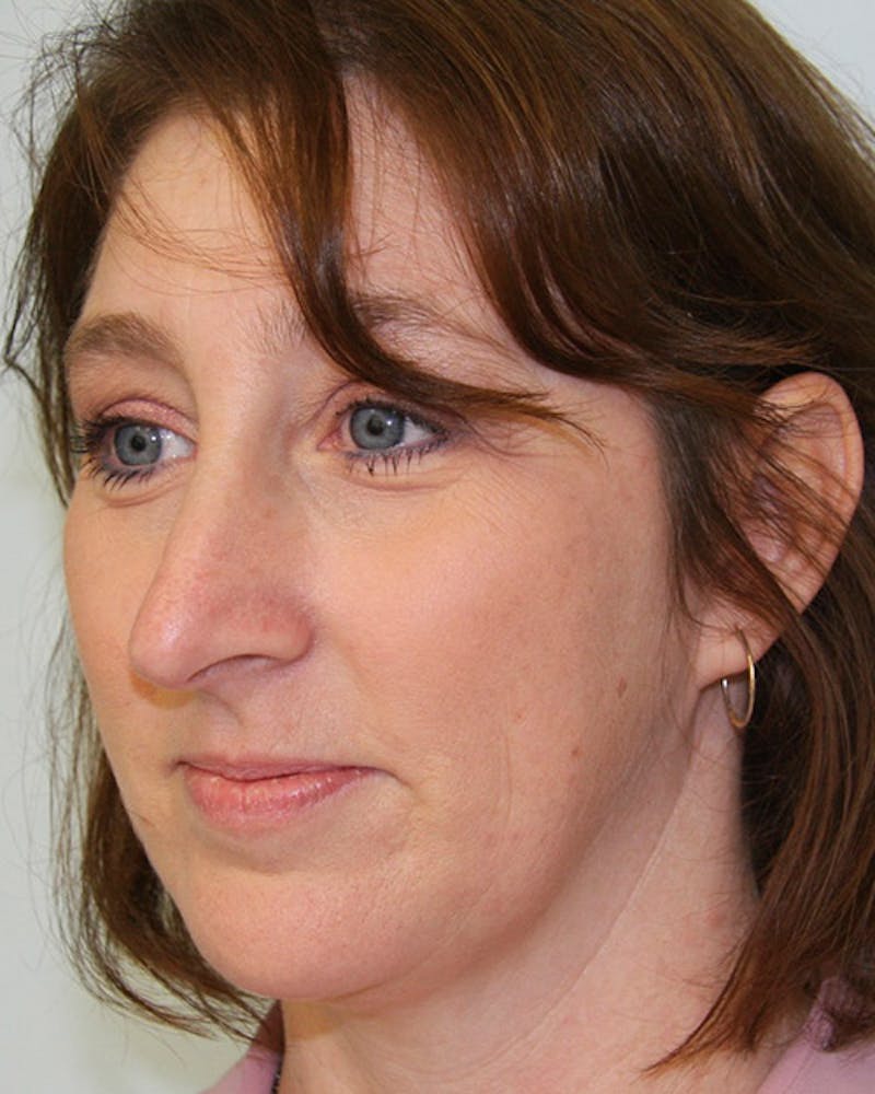 Rhinoplasty Before & After Gallery - Patient 143522100 - Image 3