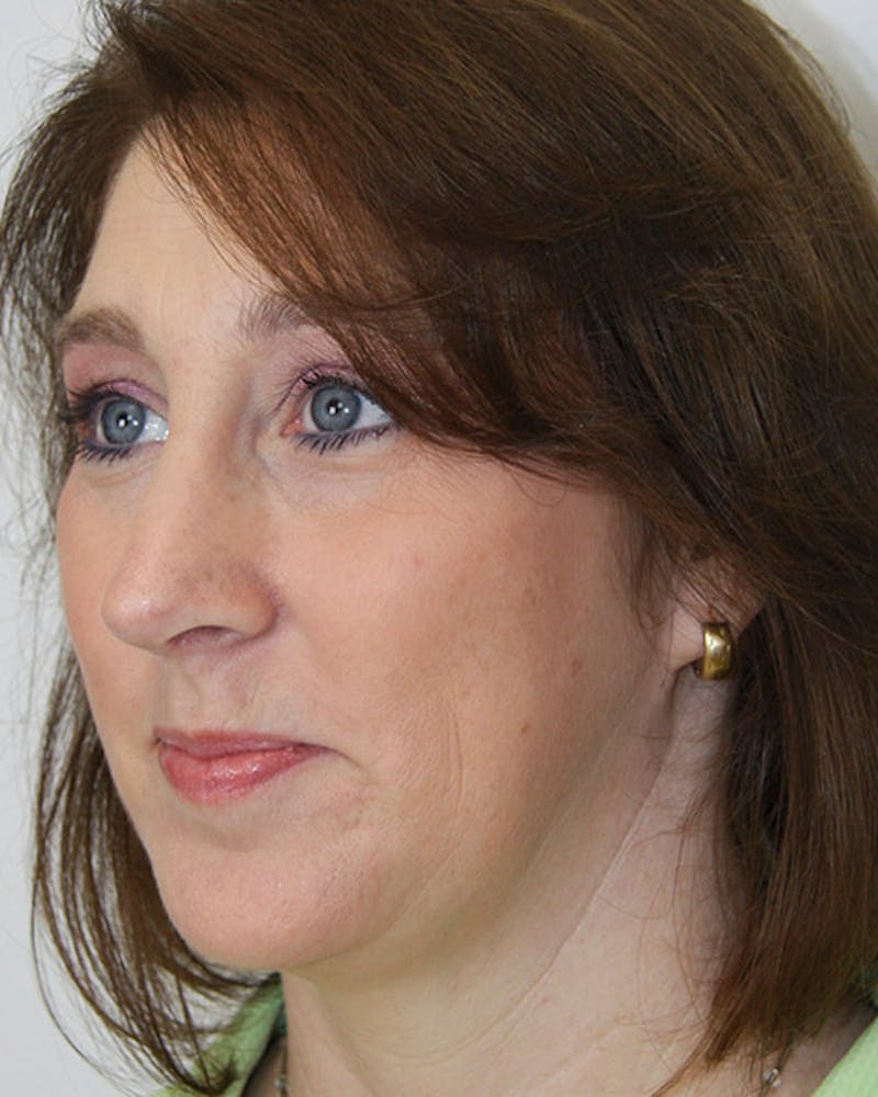 Rhinoplasty Before & After Gallery - Patient 143522100 - Image 4