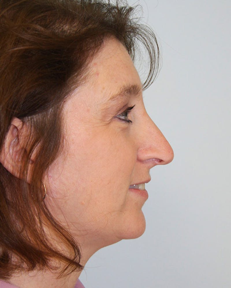 Rhinoplasty Before & After Gallery - Patient 143522100 - Image 5